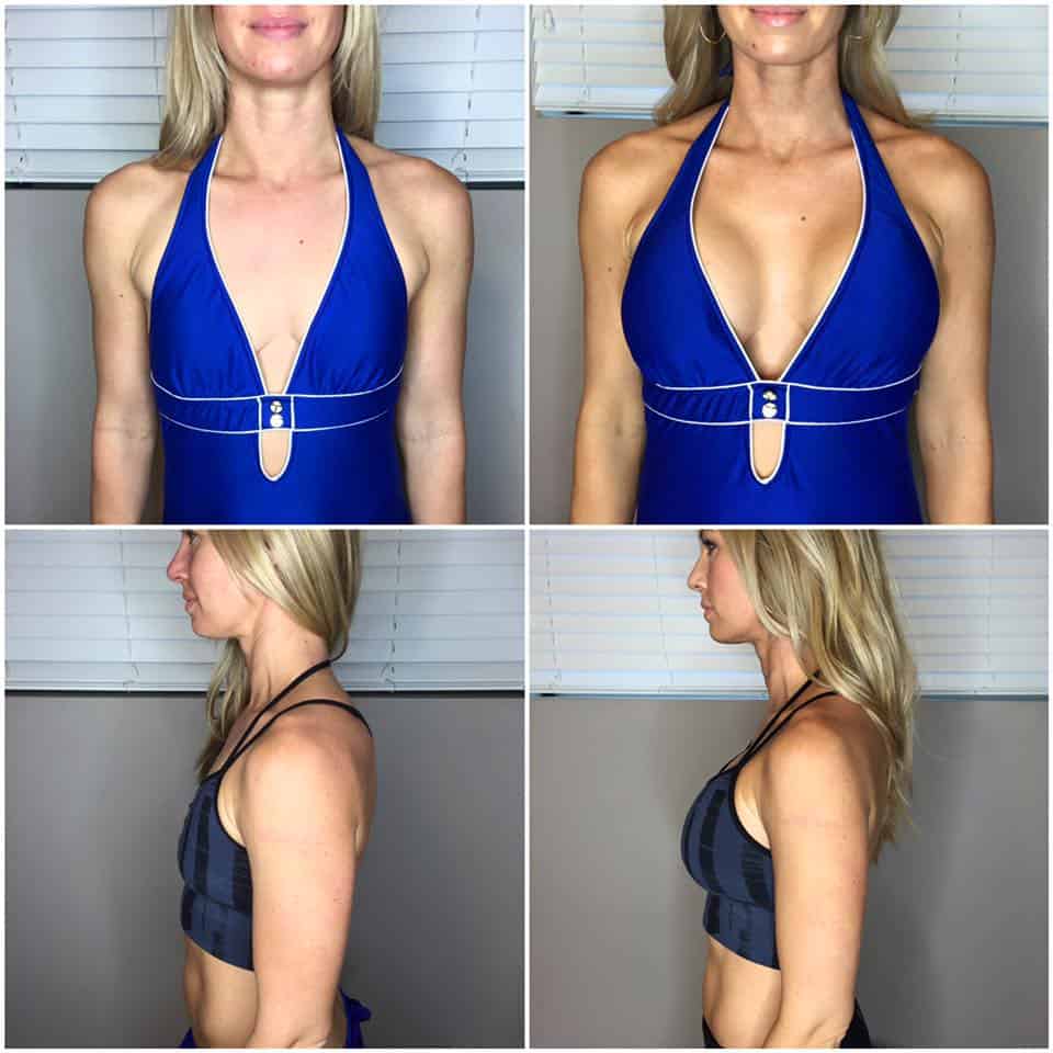 A Mom S Reason For Breast Augmentation Stacy Rody   Beforeafter 