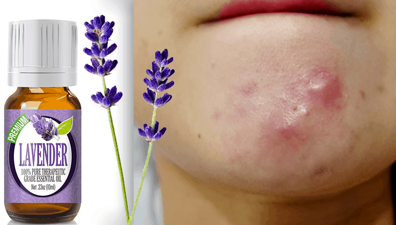 LAVENDER-ESSENTIAL-OIL-FOR-CYSTIC-ACNE-SKIN-TREATMENT
